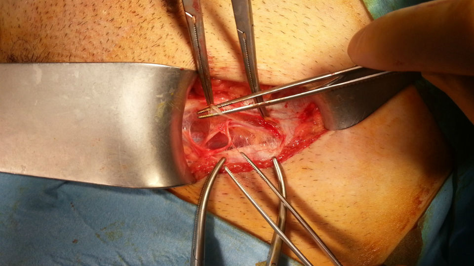 Operasi sebagai salah satu cara menyembuhkan hernia